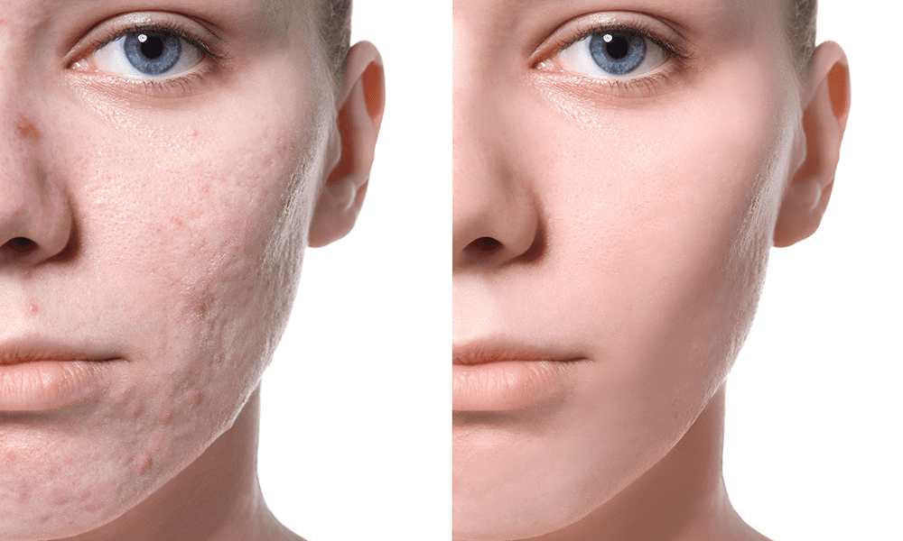 ACNE AND ACNE SCAR LASERS